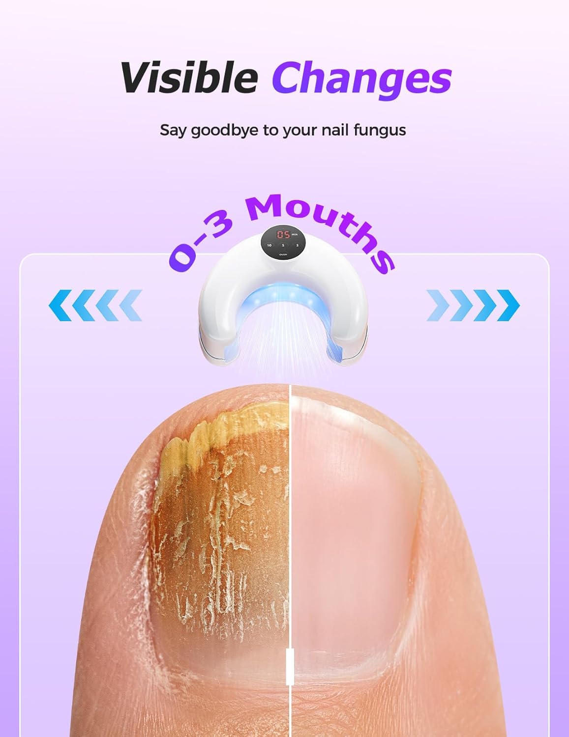 ISKIX™ BioClear - Restore Strong, Beautiful Nails by Tackling Fungus and Discoloration